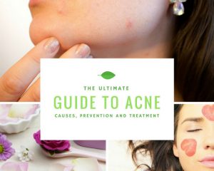 The Ultimate Guide to Acne: Causes, Prevention and Treatment